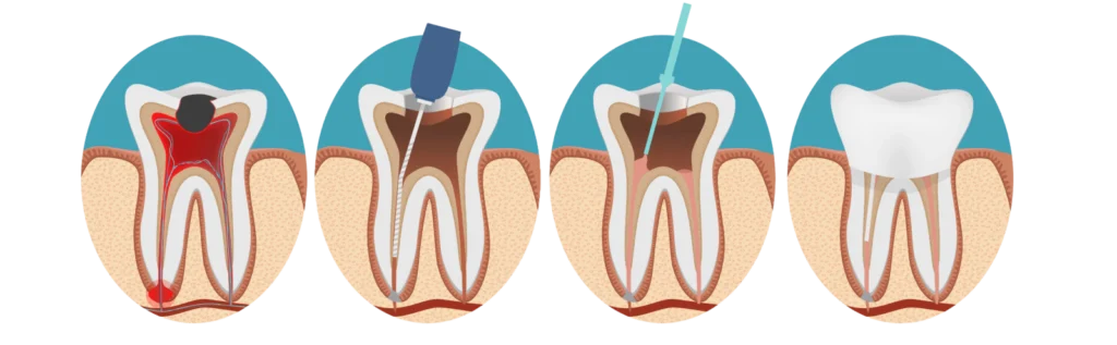 endodontie dentaire retraitement endodontique Endodontie Dentistes à Château-Arnoux-Saint-Auban