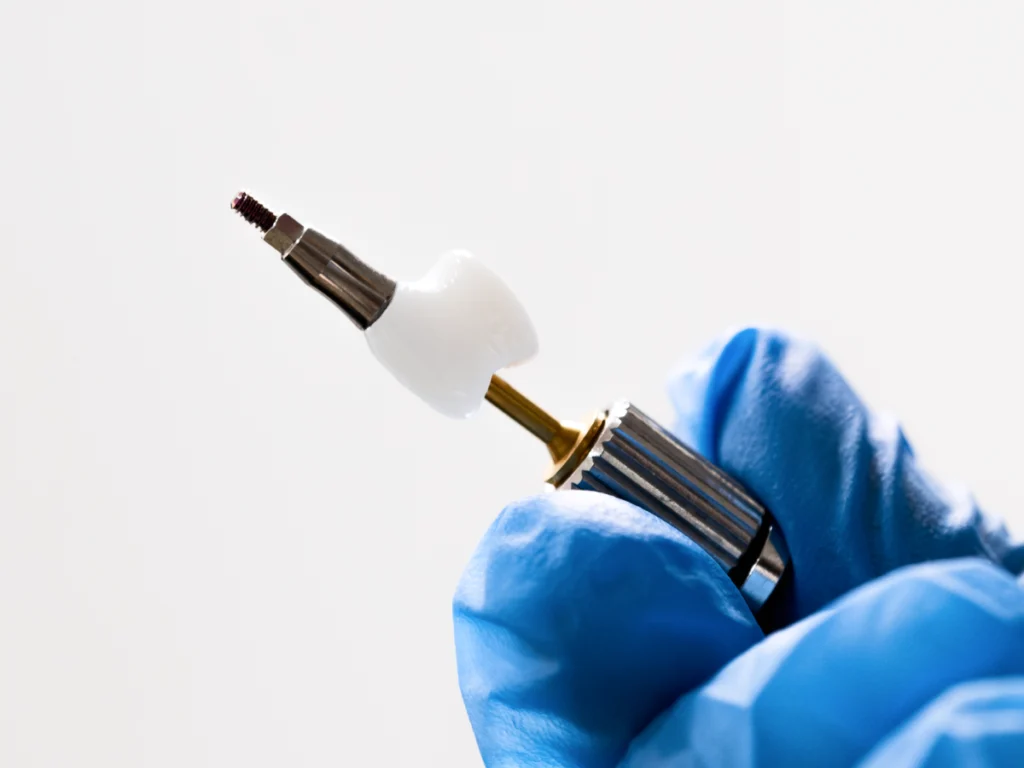 implant dentaire dent manquante Implants dentaires Dentistes à Château-Arnoux-Saint-Auban