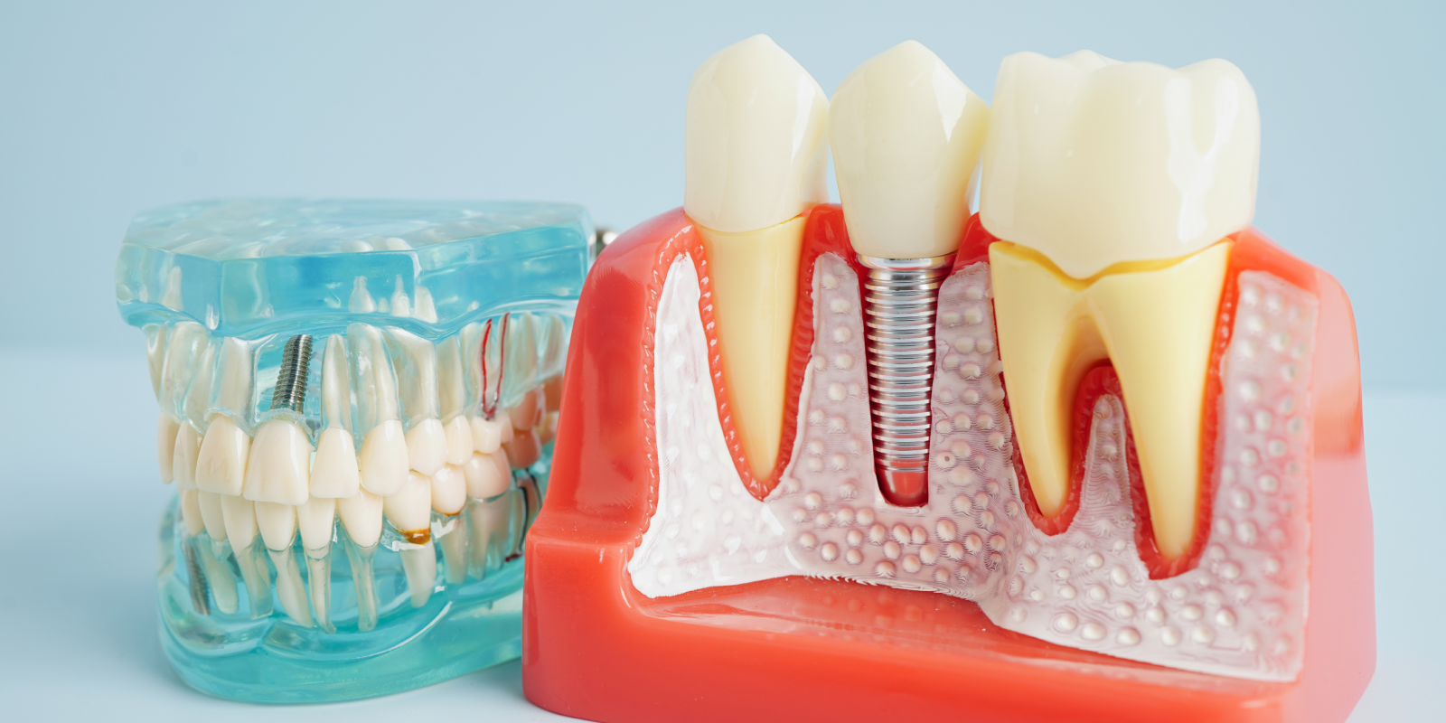 implant dentaire Implants dentaires Dentistes à Château-Arnoux-Saint-Auban