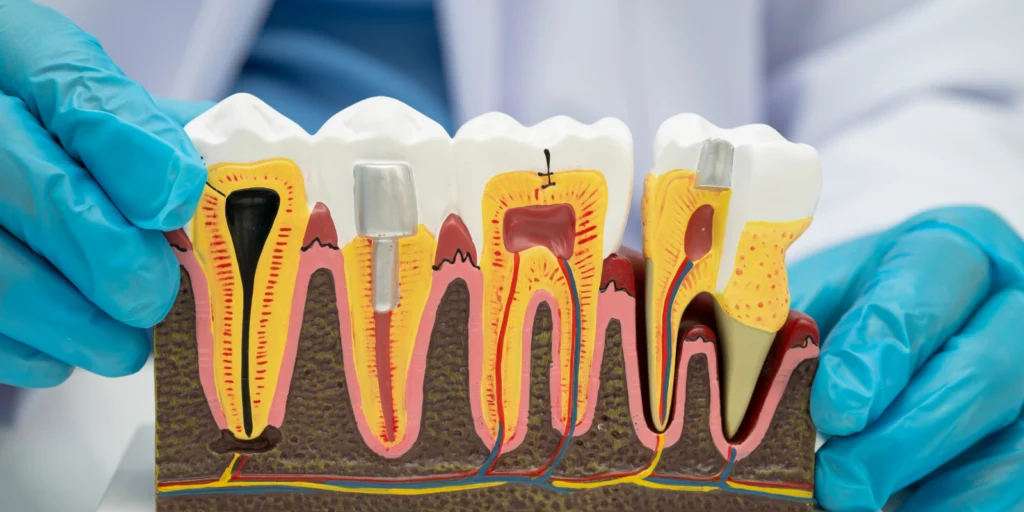 retraitement endodontique traitement canal Soins dentaires Dentistes à Château-Arnoux-Saint-Auban