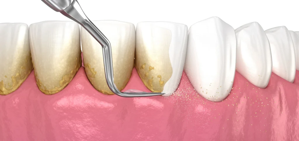 surfacage radiculaire detartrage Soins dentaires Dentistes à Château-Arnoux-Saint-Auban